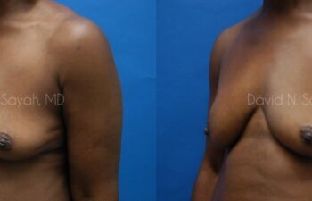 Breast Implant Revision Before and After | Sayah Institute