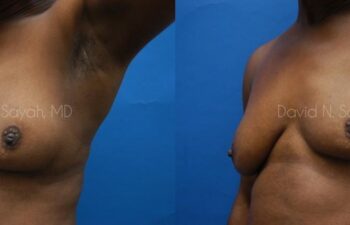 Breast Implant Revision Before and After | Sayah Institute