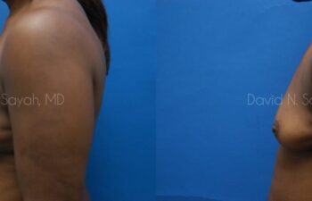 Breast Implant Revision Before and After | Sayah Institute
