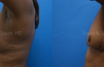 Breast Implant Revision Before and After | Sayah Institute