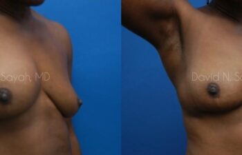 Breast Implant Revision Before and After | Sayah Institute