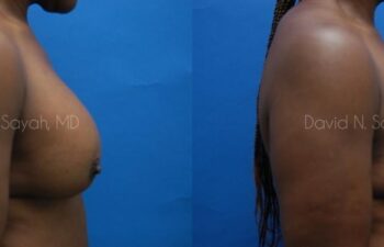 Breast Implant Revision Before and After | Sayah Institute