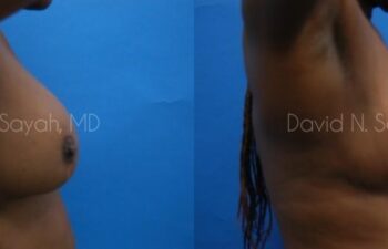 Breast Implant Revision Before and After | Sayah Institute