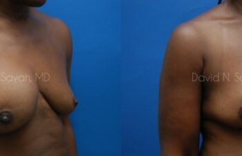 Breast Implant Revision Before and After | Sayah Institute