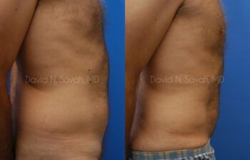 Liposuction Before and After | Sayah Institute