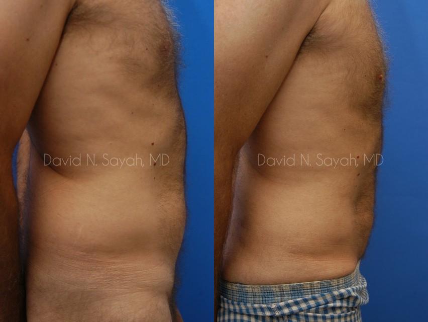 Liposuction Before and After | Sayah Institute
