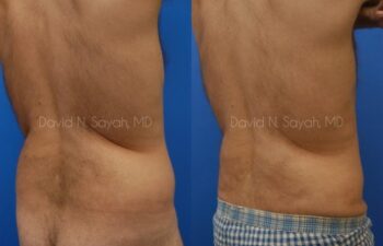 Liposuction Before and After | Sayah Institute