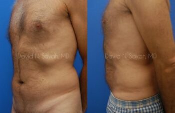 Liposuction Before and After | Sayah Institute