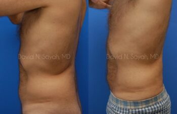 Liposuction Before and After | Sayah Institute