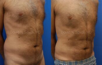 Liposuction Before and After | Sayah Institute