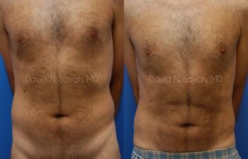 Liposuction Before and After | Sayah Institute