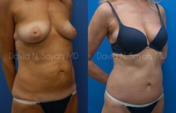 Liposuction Before and After | Sayah Institute