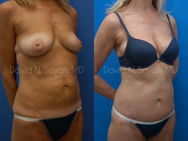 Liposuction Before and After | Sayah Institute