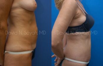 Liposuction Before and After | Sayah Institute