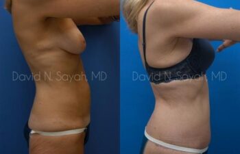 Liposuction Before and After | Sayah Institute