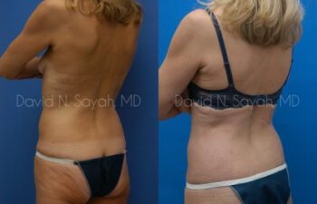 Liposuction Before and After | Sayah Institute
