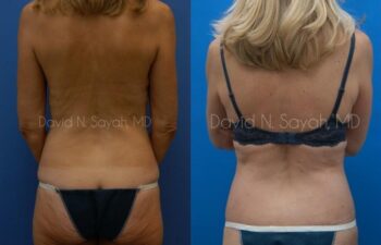 Liposuction Before and After | Sayah Institute