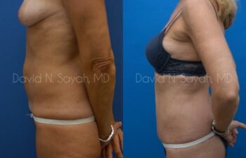 Liposuction Before and After | Sayah Institute