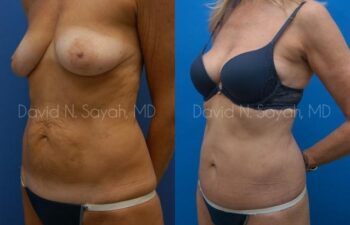 Liposuction Before and After | Sayah Institute