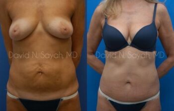Liposuction Before and After | Sayah Institute