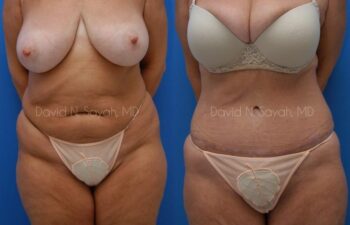 Tummy Tuck Before and After | Sayah Institute