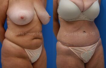 Tummy Tuck Before and After | Sayah Institute