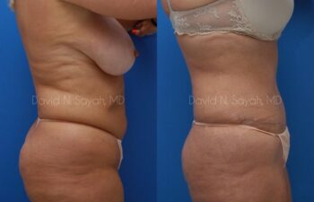 Tummy Tuck Before and After | Sayah Institute