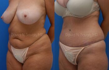 Tummy Tuck Before and After | Sayah Institute
