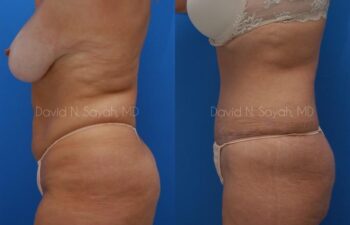 Tummy Tuck Before and After | Sayah Institute