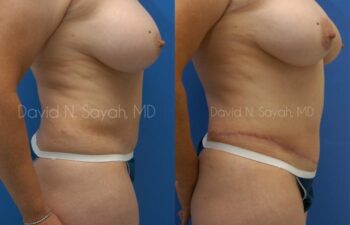 Tummy Tuck Before and After | Sayah Institute