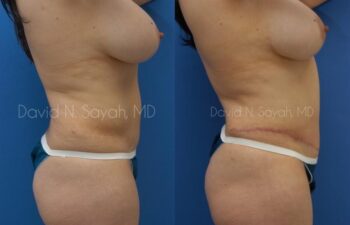 Tummy Tuck Before and After | Sayah Institute