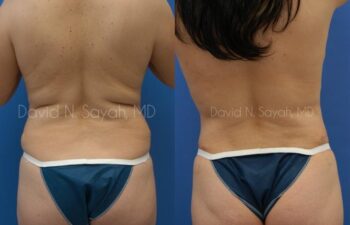 Tummy Tuck Before and After | Sayah Institute