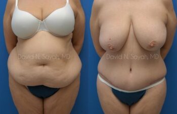 Tummy Tuck Before and After | Sayah Institute