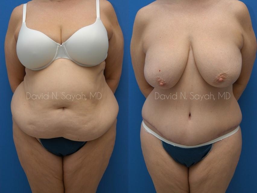 Tummy Tuck Before and After | Sayah Institute