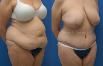 Tummy Tuck Before and After | Sayah Institute