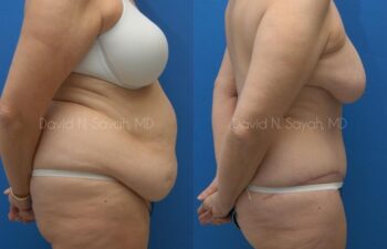 Tummy Tuck Before and After | Sayah Institute
