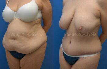 Tummy Tuck Before and After | Sayah Institute