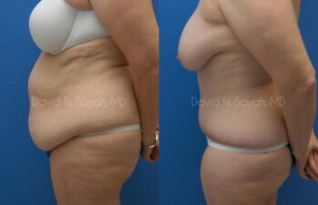 Tummy Tuck Before and After | Sayah Institute