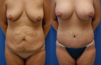 Tummy Tuck Before and After | Sayah Institute