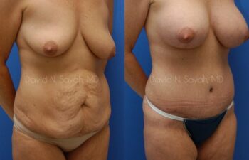 Tummy Tuck Before and After | Sayah Institute