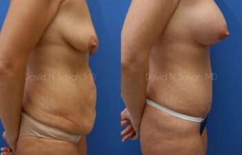 Tummy Tuck Before and After | Sayah Institute