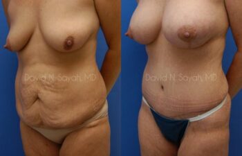 Tummy Tuck Before and After | Sayah Institute