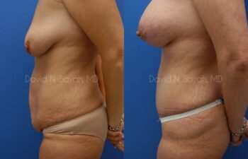 Tummy Tuck Before and After | Sayah Institute