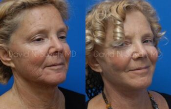 Facelift Before and After | Sayah Institute