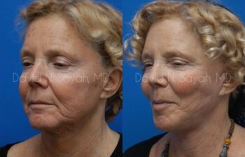 Facelift Before and After | Sayah Institute