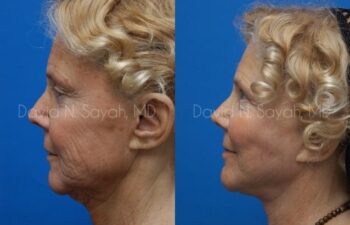 Facelift Before and After | Sayah Institute