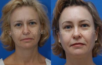 Brow Lift Before and After | Sayah Institute
