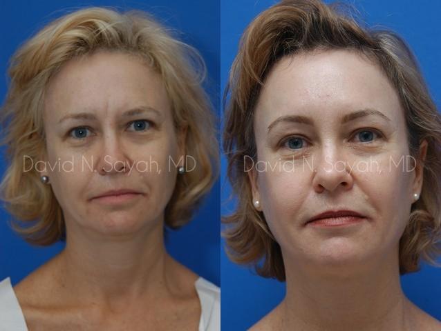 Brow Lift Before and After | Sayah Institute