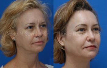 Brow Lift Before and After | Sayah Institute