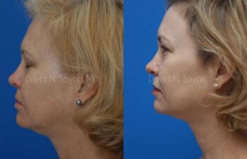 Brow Lift Before and After | Sayah Institute